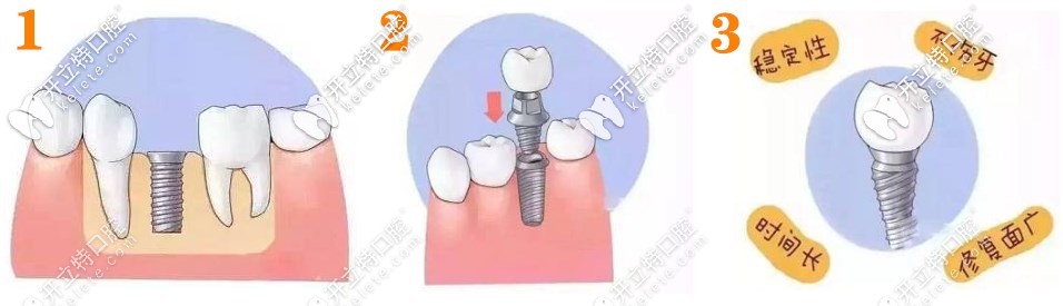 種植牙的簡(jiǎn)單流程