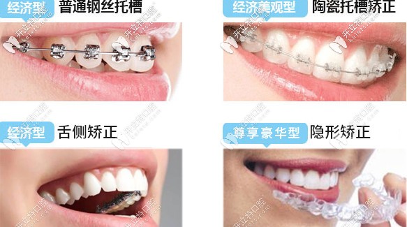 牙齒矯正器的種類