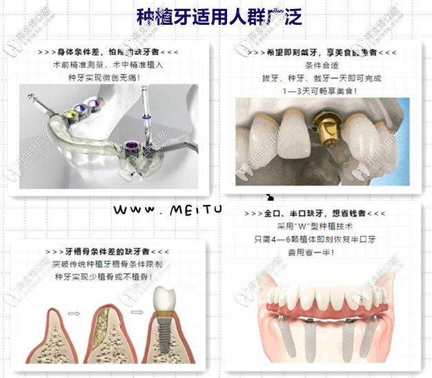種植牙的優(yōu)勢