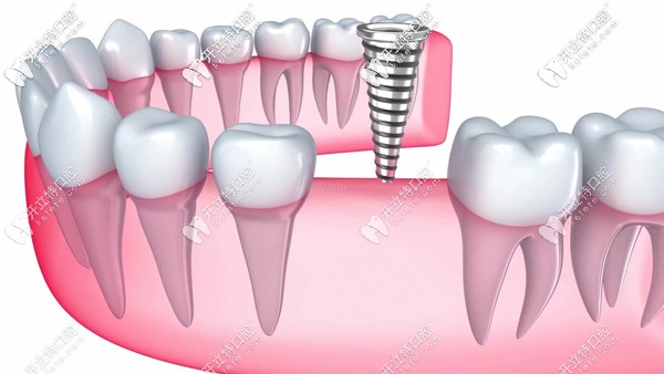廣大口腔的德國和法國等種植牙價格