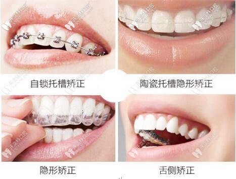牙套的幾種