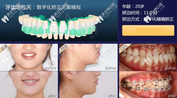 廈門(mén)麥芽口腔地包天牙齒矯正案例
