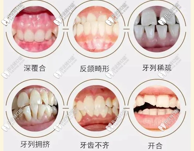 牙齒畸形主要有哪些