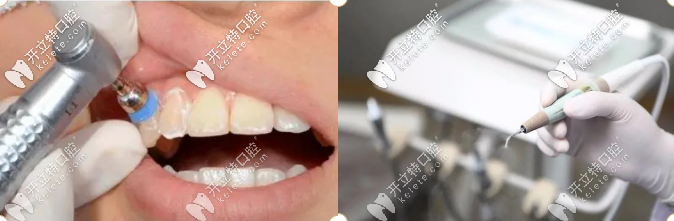 潔牙、牙修復(fù)等立減價(jià)格