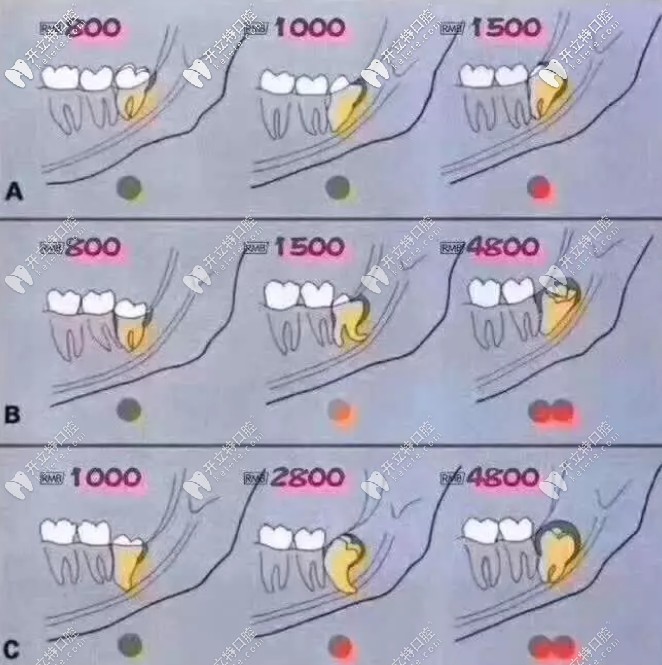 下頜遠中傾斜智齒價格表