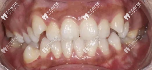 矯正前的牙齒圖 矯正前的牙齒圖