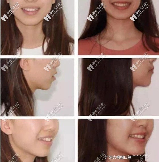 戴了60副隱適美牙套矯正虎牙后的效果 戴了60副隱適美牙套矯正虎牙后的效果