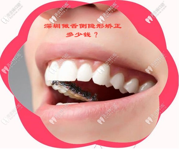 在深圳做舌側(cè)隱形矯正的收費價格是多少錢
