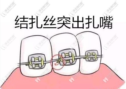 傳統(tǒng)金屬牙套