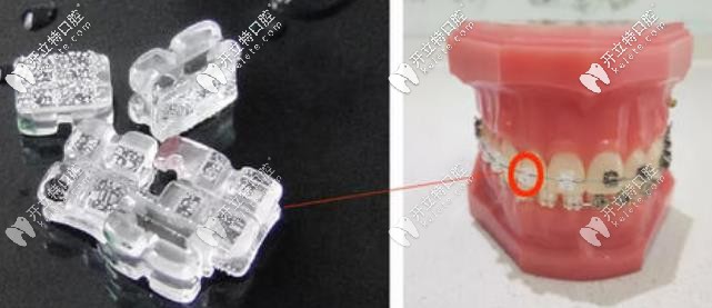 冰晶托槽矯正