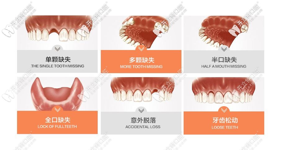 種植牙適應癥