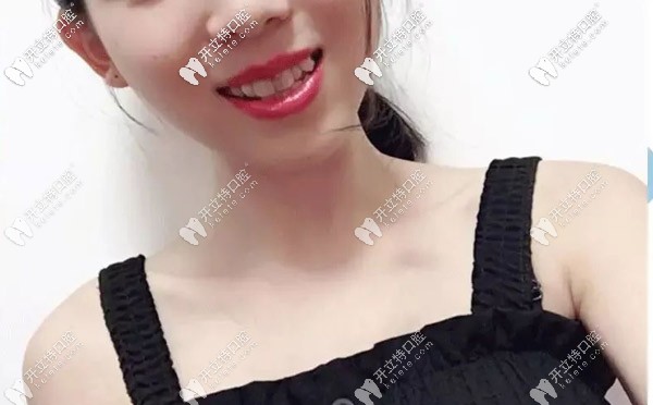 正雅日夜版隱形矯正