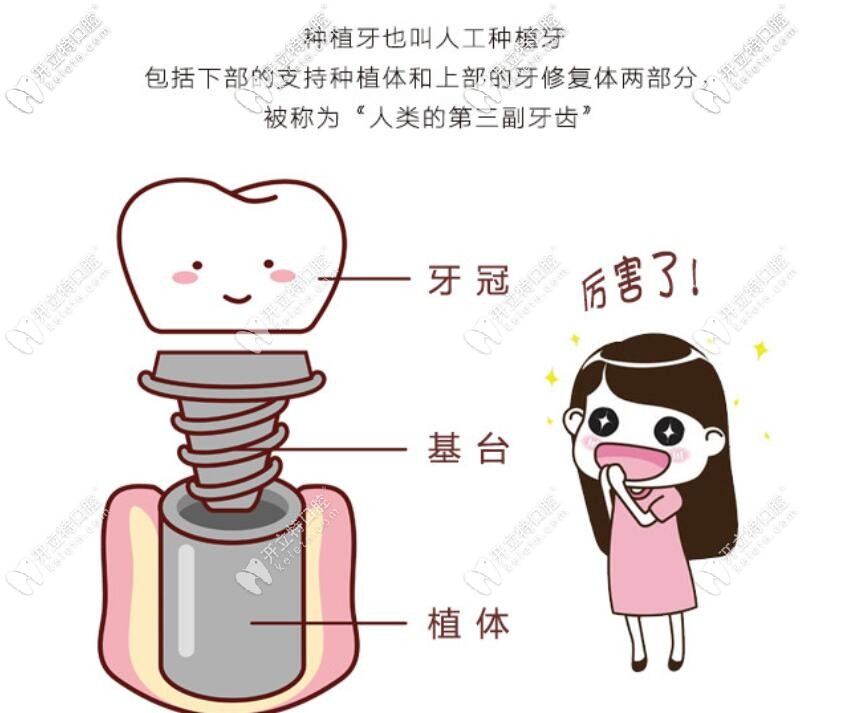 種植牙介紹