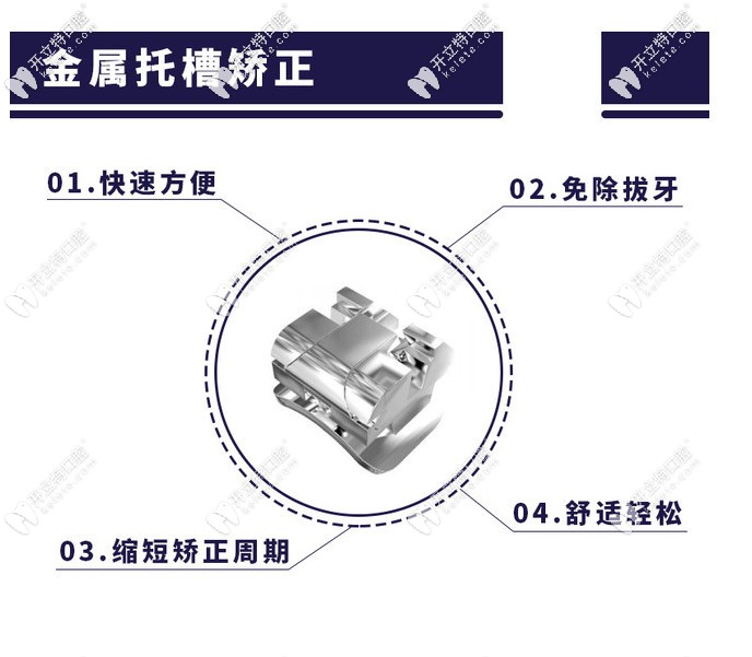 金屬自鎖托槽矯正的優(yōu)勢(shì)