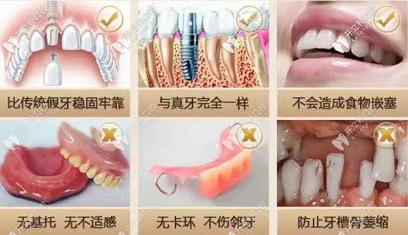 種植牙好處優(yōu)點(diǎn)