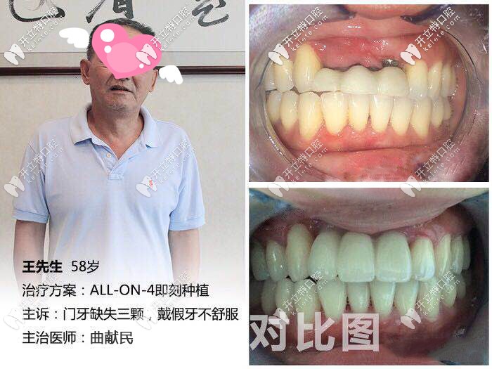 <!--<i data=20240703-sp></i>-->口腔半口種植牙效果對(duì)比圖