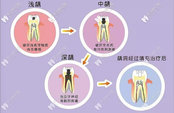 不同補(bǔ)牙技術(shù)也決定了補(bǔ)牙的收費 不同補(bǔ)牙技術(shù)也決定了補(bǔ)牙的收費