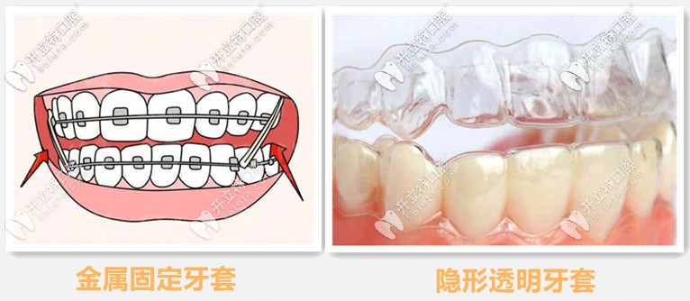 金屬牙套與隱形牙套