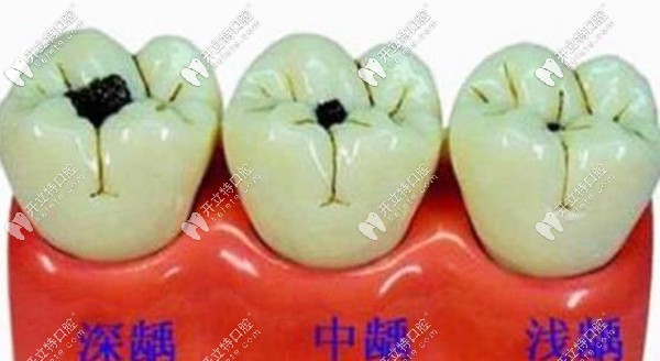 齲齒程度決定了補(bǔ)牙價格 齲齒程度決定了補(bǔ)牙價格