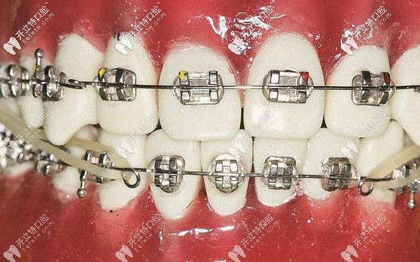 牙齒正畸所用的弓絲原理