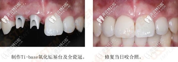 種植后戴臨時(shí)牙冠的照片