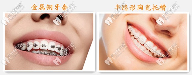 固定牙齒矯正器的分類