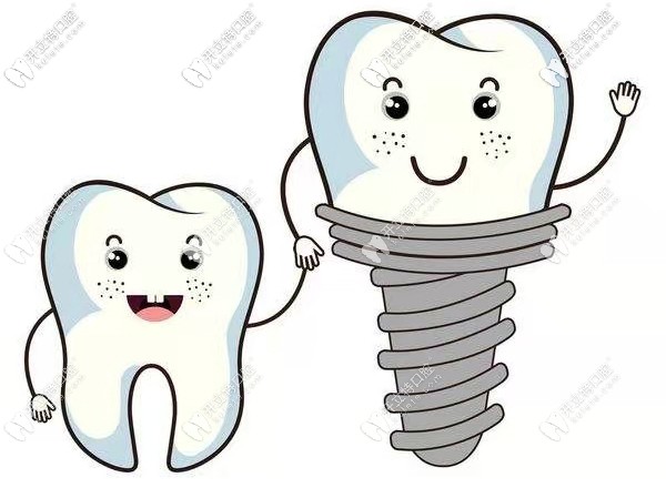 老鐵們，我知道在成都青羊區(qū)華美牙科做種植牙多少錢啦！