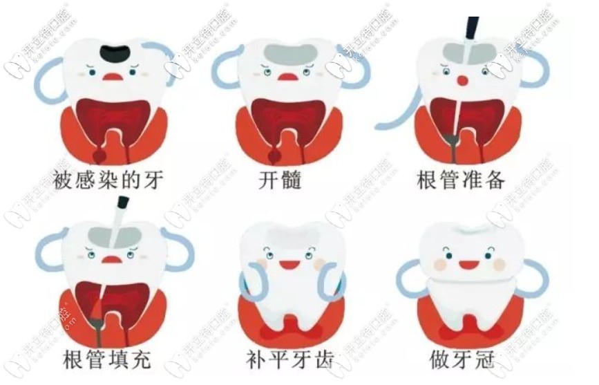 根管治療的步驟