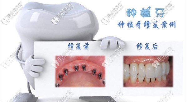 在菏澤做種植牙多少錢一顆？