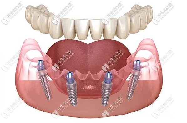 “我太想知道南京做all-on-4種植牙哪家牙科好了！”
