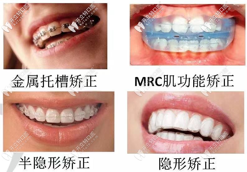 成人和兒童牙齒矯正的價(jià)格