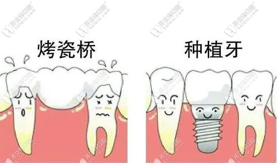 種植修復(fù)和固定牙冠相比,醫(yī)生為什么選擇前者