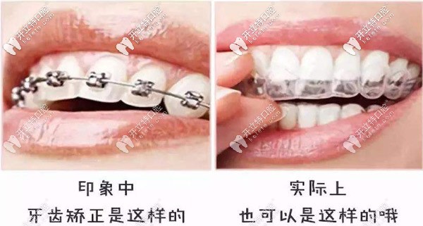 告別鋼牙妹，別錯(cuò)過隱形矯正哦