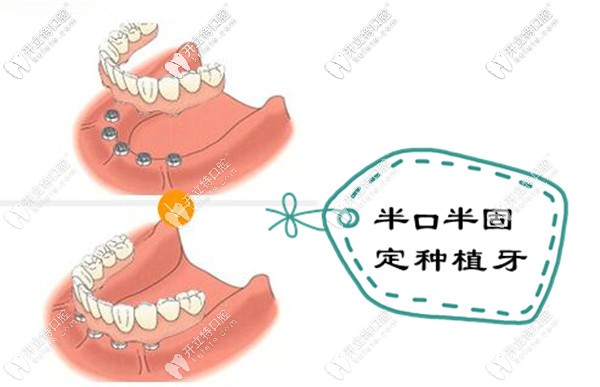 福州維樂口腔半口半固定種植牙優(yōu)點(diǎn)