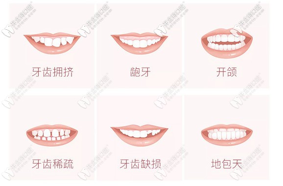 需要矯正牙齒的癥狀