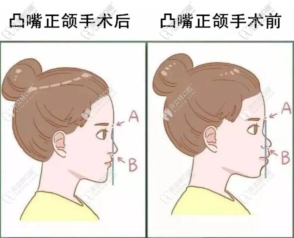 凸嘴正頜手術(shù)前后對比圖
