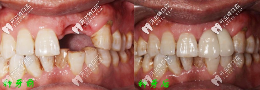 種牙前后對(duì)比