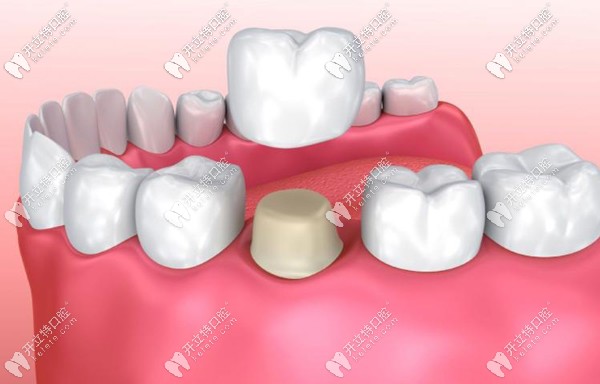 全瓷牙是否價(jià)格越貴質(zhì)量越好？