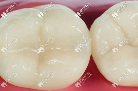 美學(xué)補(bǔ)牙修復(fù)后的效果圖