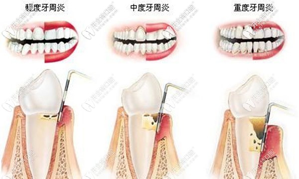 上海哪里有丹麥水冷激光治療，大概需要多少費(fèi)用？