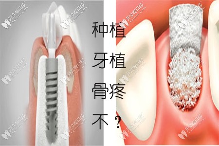 天哪！種植牙填骨粉太疼了？上門牙種植一定要植骨粉嗎