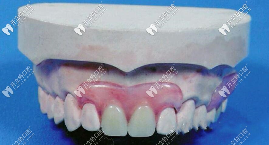 我老爸當初用的就是類似下邊的這個義齒