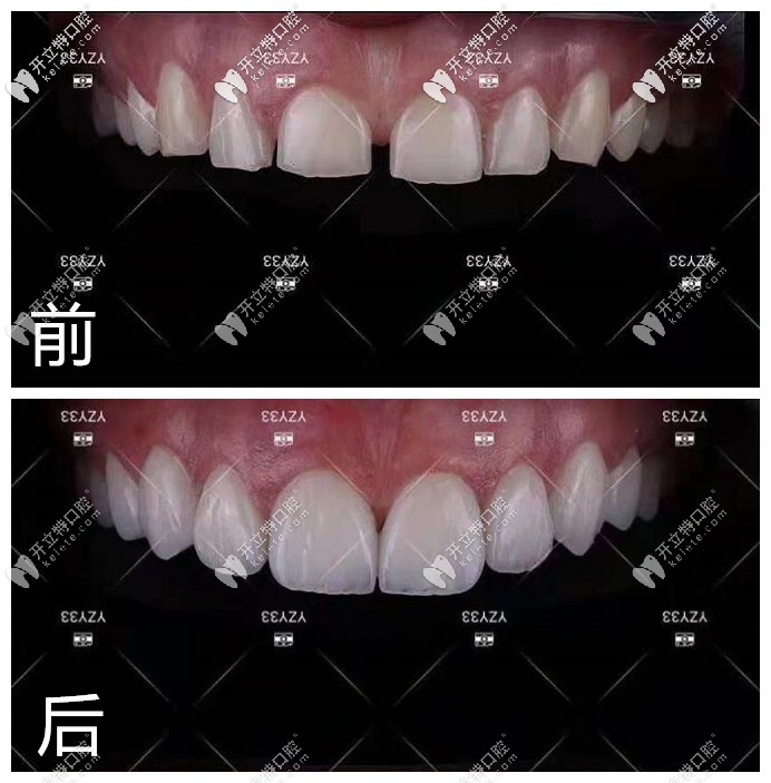 納米水晶瓷貼面修復(fù)半口牙前后對比照片