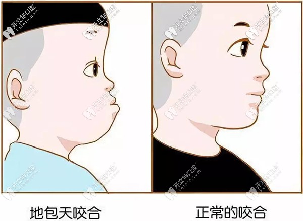 地包天和正常的面型對(duì)比圖