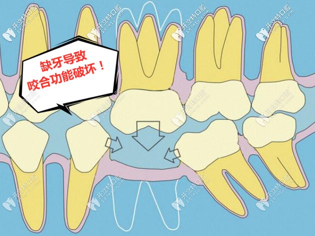 缺牙導(dǎo)致咬合功能破裂