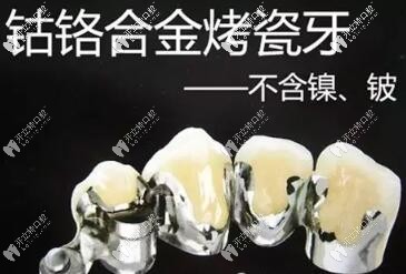 鈷鉻烤瓷牙現(xiàn)在還有人用嗎?別沖動(dòng)!先了解一下優(yōu)缺點(diǎn)