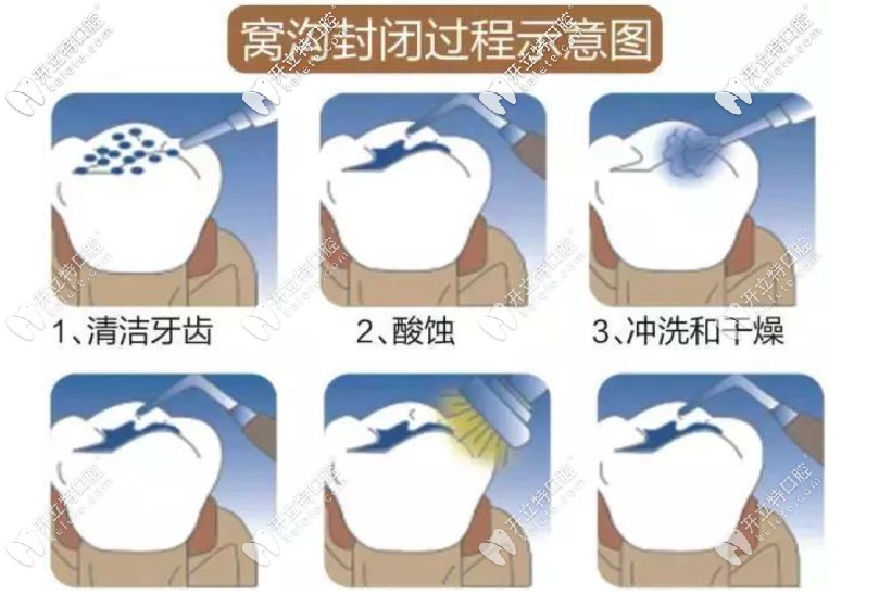窩溝封閉流程