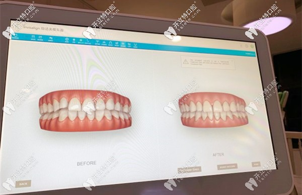 天河柏德口腔的3D口掃儀