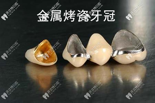 柳州華山口腔醫(yī)院的烤瓷牙