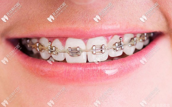 張冰醫(yī)生擅長(zhǎng)各類(lèi)牙齒矯正技術(shù)